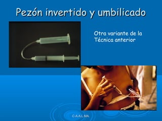 C.A.A.L.MA.C.A.A.L.MA.
Pezón invertido y umbilicadoPezón invertido y umbilicado
Otra variante de la
Técnica anterior
 