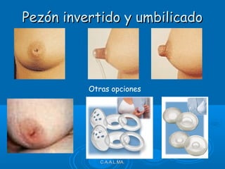 C.A.A.L.MA.C.A.A.L.MA.
Pezón invertido y umbilicadoPezón invertido y umbilicado
Otras opciones
 