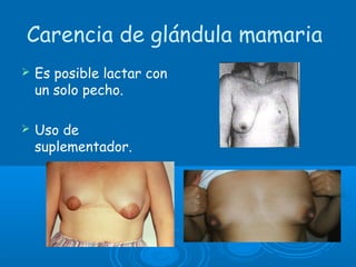 Carencia de glándula mamaria
 Es posible lactar con
un solo pecho.
 Uso de
suplementador.
 