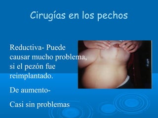 Cirugías en los pechos
Reductiva- Puede
causar mucho problema,
si el pezón fue
reimplantado.
De aumento-
Casi sin problemas
 