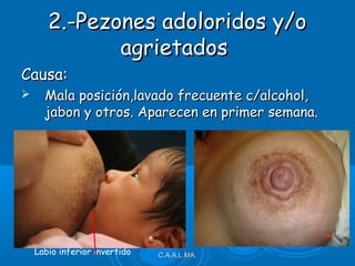 2.-Pezones adoloridos y/o2.-Pezones adoloridos y/o
agrietadosagrietados
Causa:Causa:
 Mala posición,lavado frecuente c/alcohol,Mala posición,lavado frecuente c/alcohol,
jabon y otros. Aparecen en primer semana.jabon y otros. Aparecen en primer semana.
C.A.A.L.MA.C.A.A.L.MA.Labio inferior invertido
 