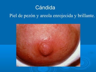 Piel de pezón y areola enrojecida y brillante.
Cándida
 