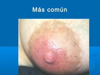 Más común
 
