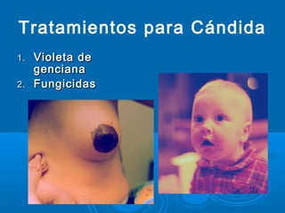 Tratamientos para Cándida
1.1. Violeta deVioleta de
gencianagenciana
2.2. FungicidasFungicidas
 