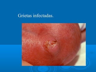 Grietas infectadas.
 