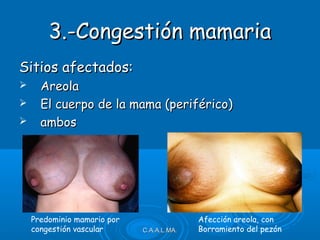 C.A.A.L.MA.C.A.A.L.MA.
3.-Congestión mamaria3.-Congestión mamaria
Sitios afectados:Sitios afectados:
 AreolaAreola
 El cuerpo de la mama (periférico)El cuerpo de la mama (periférico)
 ambosambos
Predominio mamario por
congestión vascular
Afección areola, con
Borramiento del pezón
 