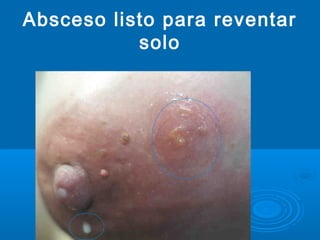 Absceso listo para reventar
solo
 