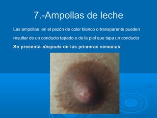 7.-Ampollas de leche
Las ampollas en el pezón de color blanco o transparente pueden
resultar de un conducto tapado o de la piel que tapa un conducto
Se presenta después de las primeras semanas
 