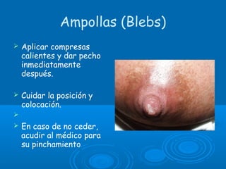 Ampollas (Blebs)
 Aplicar compresas
calientes y dar pecho
inmediatamente
después.
 Cuidar la posición y
colocación.
  
 En caso de no ceder,
acudir al médico para
su pinchamiento
 