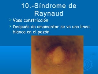 10.-Síndrome de
Raynaud
 Vaso constricción
 Después de amamantar se ve una linea
blanca en el pezón
 