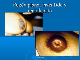 Pezón plano, invertido yPezón plano, invertido y
umbilicadoumbilicado
C.A.A.L.MA.C.A.A.L.MA.
 