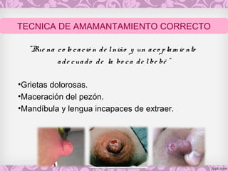 “Bue na co lo cació n de lniño y un aco plam ie nto
ade cuado de la bo ca de lbe bé ”
•Grietas dolorosas.
•Maceración del pezón.
•Mandíbula y lengua incapaces de extraer.
TECNICA DE AMAMANTAMIENTO CORRECTO
 