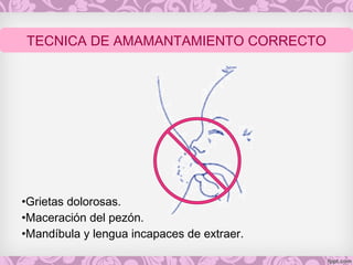 •Grietas dolorosas.
•Maceración del pezón.
•Mandíbula y lengua incapaces de extraer.
TECNICA DE AMAMANTAMIENTO CORRECTO
 