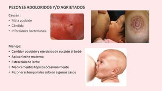 Causas :
• Mala posición
• Cándida
• Infecciones Bacterianas.
Manejo:
• Cambiar posición y ejercicios de succión al bebé
• Aplicar leche materna
• Extracción de leche
• Medicamentos tópicosocasionalmente
• Pezonerastemporales solo en algunos casos
PEZONES ADOLORIDOS Y/O AGRIETADOS
 