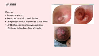 Manejo:
• Aumentar tetadas
• Extracción manual o con tiraleches
• Compresas calientes mientras se extrae leche
• Antibióticos, antipiréticosy analgésicos
• Continuar lactando del lado afectado
MASTITIS
 