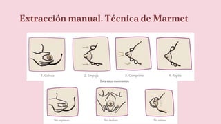 Extracción manual. Técnica de Marmet
 