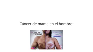 Cáncer de mama en el hombre.
 