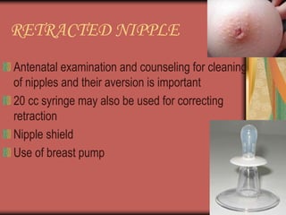 RETRACTED NIPPLE
Antenatal examination and counseling for cleaning
of nipples and their aversion is important
20 cc syringe may also be used for correcting
retraction
Nipple shield
Use of breast pump
 
