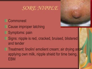 SORE NIPPLE
Commonest
Cause improper latching
Symptoms: pain
Signs: nipple is red, cracked, bruised, blistered
and tender
Treatment: linolin/ emolient cream; air drying and
applying own milk, nipple shield for time being,
EBM
 