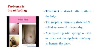 Problems in
breastfeeding  Treatment is started after birth of
the baby.
 The nipple is manually stretched &
rolled out several times a day.
 A pump or a plastic syringe is used
to draw out the nipple & the baby
is then put the baby.
 