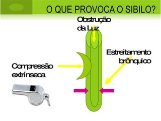 O QUE PROVOCA O SIBILO? Compressão extrínseca Estreitamento brônquico Obstrução da Luz 