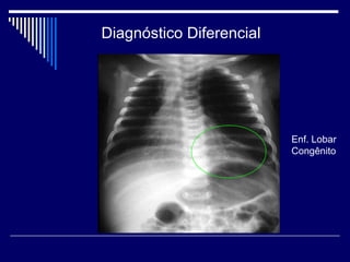 Diagnóstico Diferencial 
Enf. Lobar 
Congênito 
 
