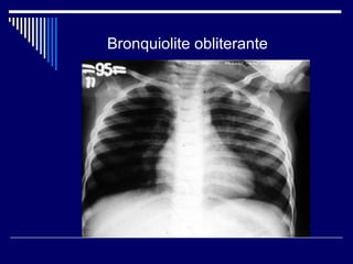 Bronquiolite obliterante 
 