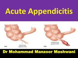 Acute Appendicitis
Dr Mohammad Manzoor Mashwani
 