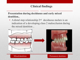 Clinical findings
Presentation during deciduous and early mixed
dentition..
• Adistal step relationship 2nd deciduous molars is an
indication of a devoloping class 2 malocclusion during
the mixed dentition ..
Mixed dentition Permanent dentition
 