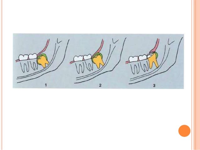 Dent Enclavée Definition  . A Depression Or Hollow Made By A Blow Or By Pressure.