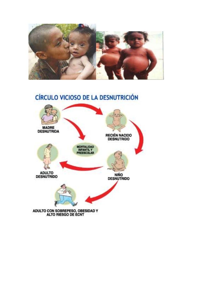La desnutrición infantil es causa de distintos tipos de