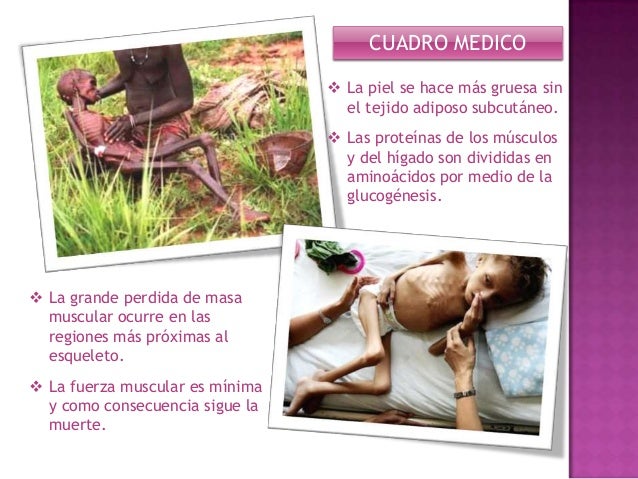 La desnutricion - Cuadro clinico - sintomas y causas La desnutricion - Cuadro clinico - sintomas y causas