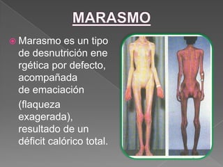  Marasmo   es un tipo
 de desnutrición ene
 rgética por defecto,
 acompañada
 de emaciación
 (flaqueza
 exagerada),
 resultado de un
 déficit calórico total.
 