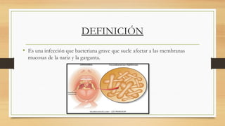 Jsjsnd LA DIFTERIA GABI.pptx sjsjdbdjwijwjdjsjsjdnd | PPTX