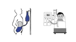 La diálisis peritoneal como opción dialítica.pptx