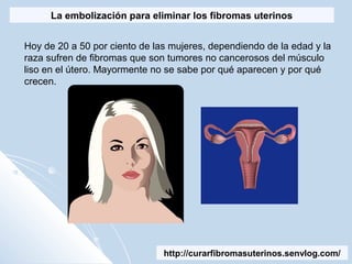 http://curarfibromasuterinos.senvlog.com/
La embolización para eliminar los fibromas uterinos
Hoy de 20 a 50 por ciento de las mujeres, dependiendo de la edad y la
raza sufren de fibromas que son tumores no cancerosos del músculo
liso en el útero. Mayormente no se sabe por qué aparecen y por qué
crecen.
 