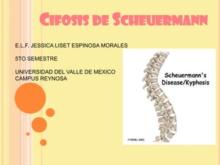 CIFOSIS DE SCHEUERMANN
E.L.F. JESSICA LISET ESPINOSA MORALES
5TO SEMESTRE
UNIVERSIDAD DEL VALLE DE MEXICO
CAMPUS REYNOSA

 