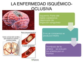 LA ENFERMEDAD ISQUÉMICO-
OCLUSIVA
Isquemia: Parte del
tejido cerebral es
deprivado de
irrigación sanguínea
Si no se compensa se
produce infarto
Trombosis de la
arteria: se ocluyen
las arterias por un
trombo
 
