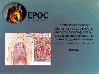 La enfermedad pulmonar
obstructiva crónica, o EPOC, es
una enfermedad progresiva que
causa dificultad para respirar. La
palabra "progresiva" indica que
la enfermedad empeora con el
tiempo.
 