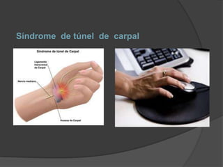 Síndrome de túnel de carpal
 
