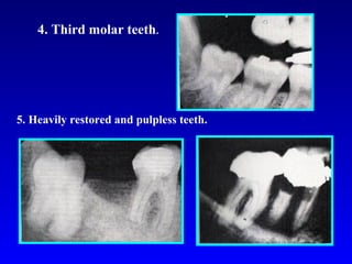 6. Isolated upper molar for a long time.

 