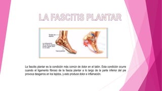 La fascitis plantar es la condición más común de dolor en el talón. Esta condición ocurre
cuando el ligamento fibroso de la fascia plantar a lo largo de la parte inferior del pie
provoca desgarros en los tejidos, y esto produce dolor e inflamación.
 