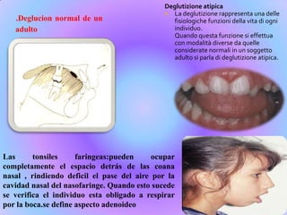 .Deglucion normal de un
adulto
Deglutizione atipica
 La deglutizione rappresenta una delle
fisiologiche funzioni della vita di ogni
individuo.
Quando questa funzione si effettua
con modalità diverse da quelle
considerate normali in un soggetto
adulto si parla di deglutizione atipica.
Las tonsiles faringeas:pueden ocupar
completamente el espacio detrás de las coana
nasal , rindiendo deficil el pase del aire por la
cavidad nasal del nasofaringe. Quando esto sucede
se verifica el individuo esta obligado a respirar
por la boca.se define aspecto adenoideo
 