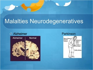 Malalties Neurodegeneratives
Alzheimer Parkinson
 