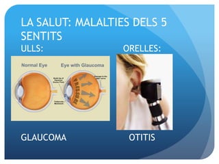 LA SALUT: MALALTIES DELS 5
SENTITS
ULLS: ORELLES:
GLAUCOMA OTITIS
 