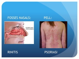 FOSSES NASALS: PELL:
RINITIS PSORIASI
 
