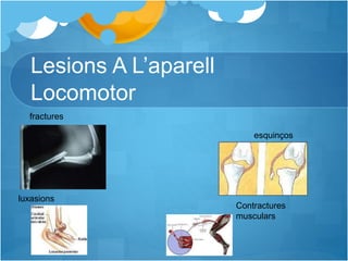 Lesions A L’aparell
Locomotor
esquinços
Contractures
musculars
fractures
luxasions
 