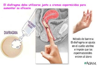 El diafragma debe utilizarse junto a cremas espermicidas para
aumentar su eficacia
 