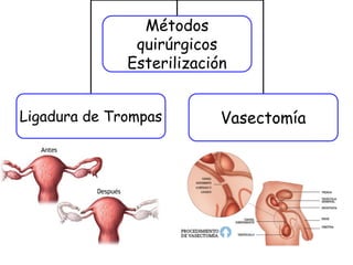 Métodos
quirúrgicos
Esterilización
Ligadura de Trompas Vasectomía
 