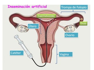 Inseminación artificial
 